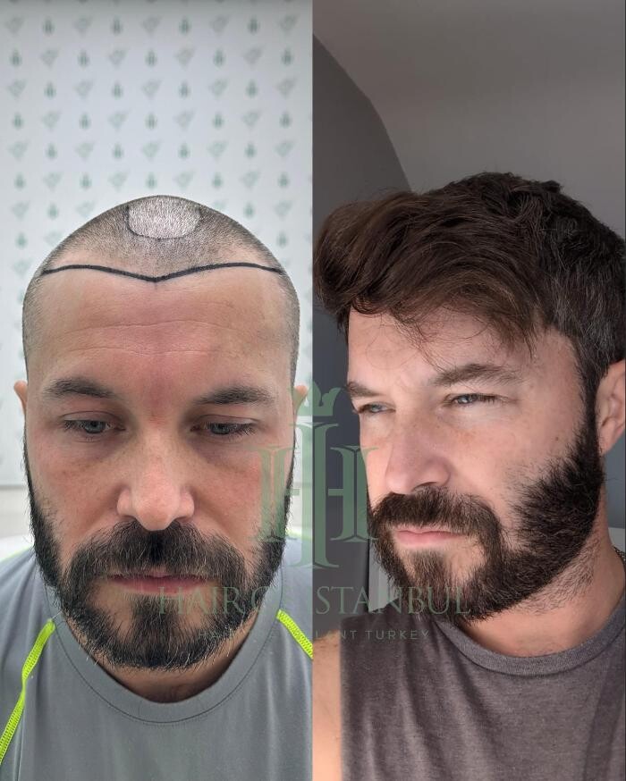 Images Hair of Istanbul | Hair Transplant Clinic