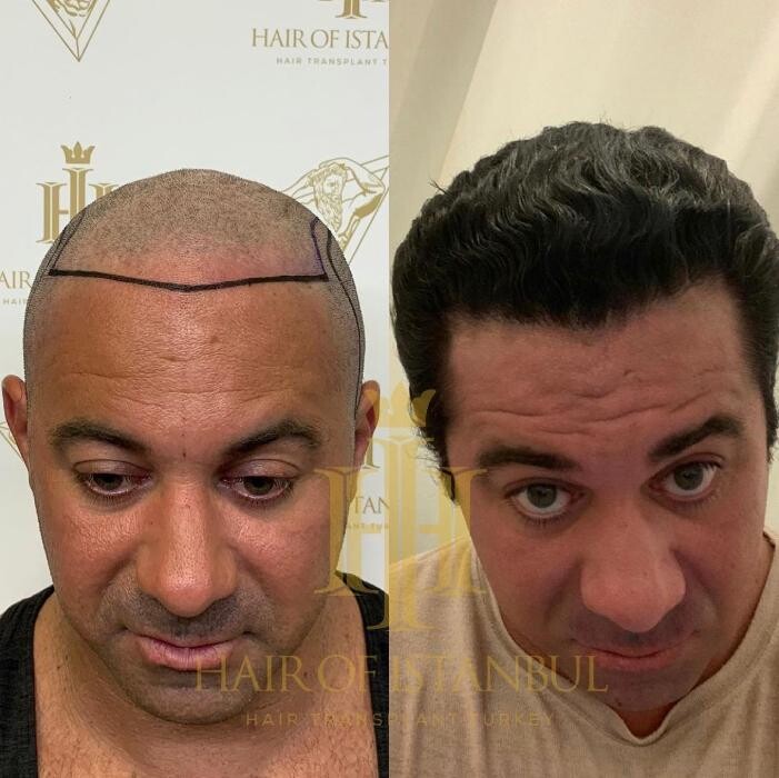 Images Hair of Istanbul | Hair Transplant Clinic