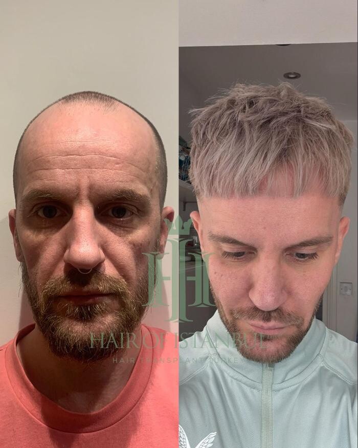 Images Hair of Istanbul | Hair Transplant Clinic
