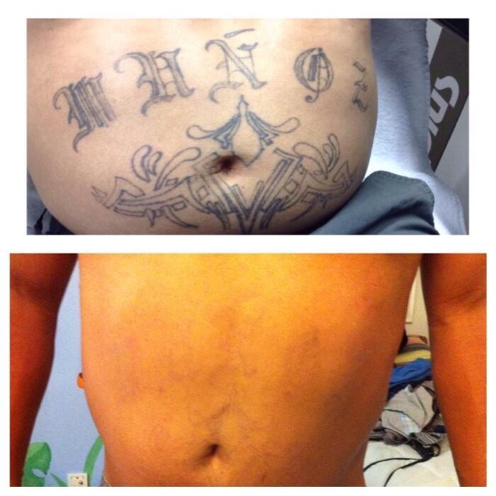 Images Removery Tattoo Removal & Fading
