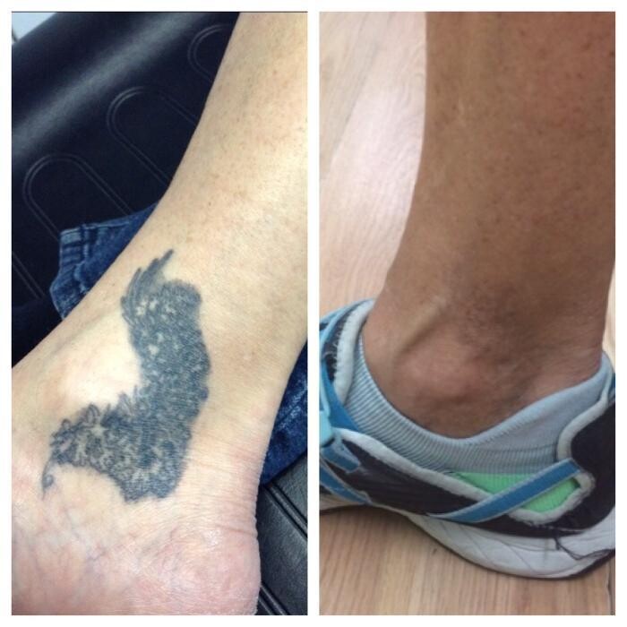 Images Removery Tattoo Removal & Fading