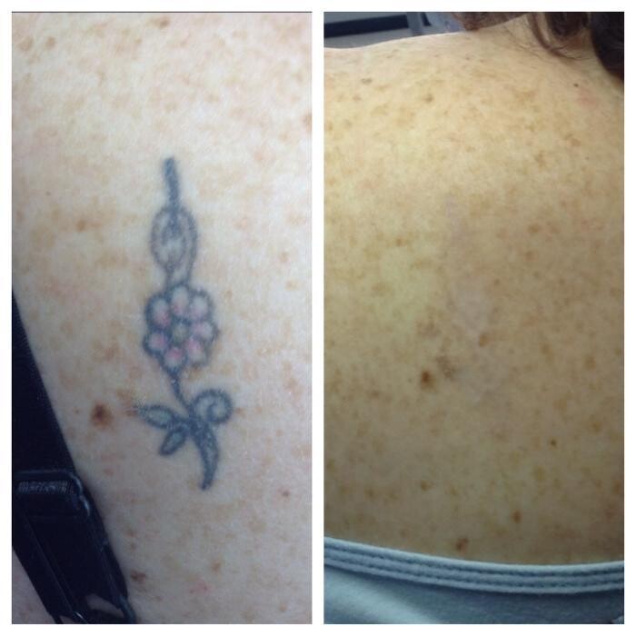 Images Removery Tattoo Removal & Fading