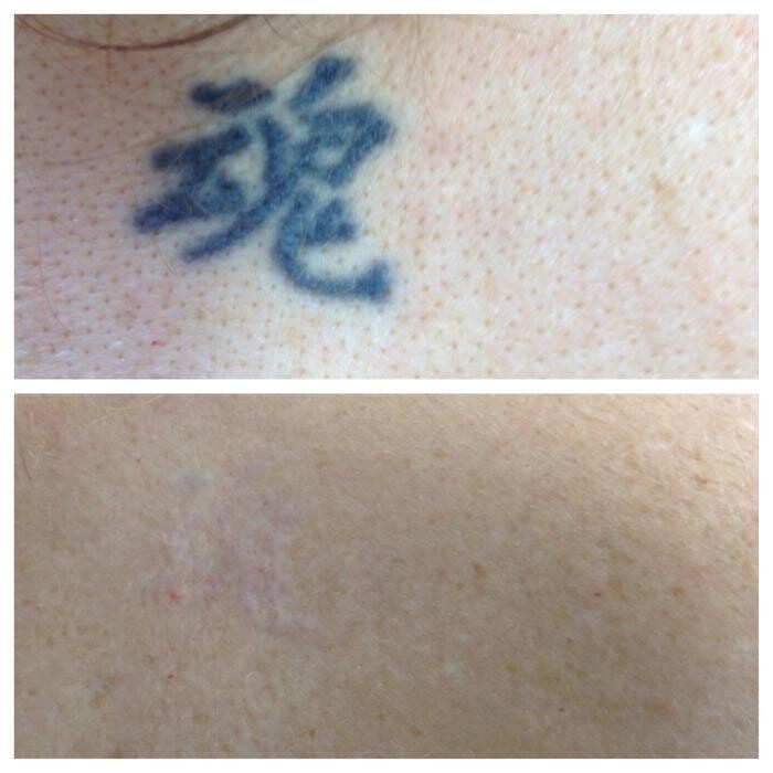 Images Removery Tattoo Removal & Fading