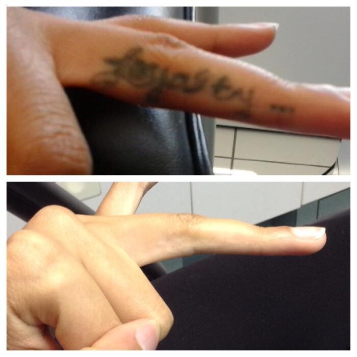 Images Removery Tattoo Removal & Fading