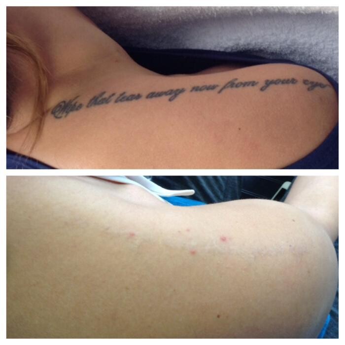 Images Removery Tattoo Removal & Fading