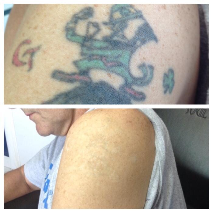 Images Removery Tattoo Removal & Fading