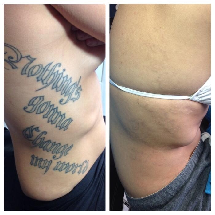 Images Removery Tattoo Removal & Fading