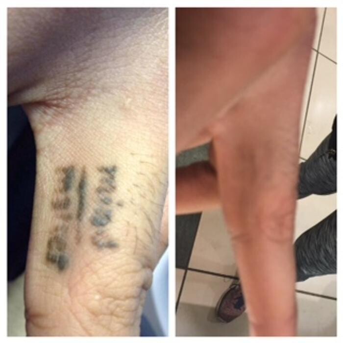 Images Removery Tattoo Removal & Fading