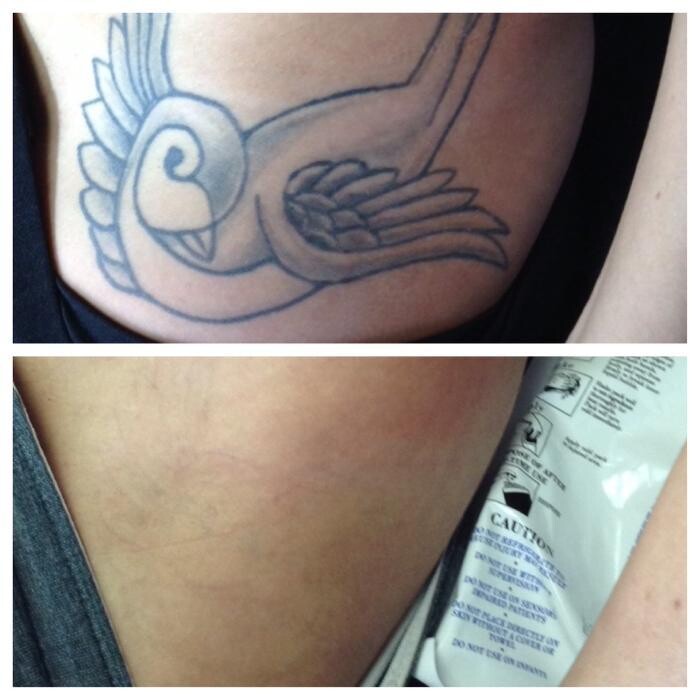 Images Removery Tattoo Removal & Fading