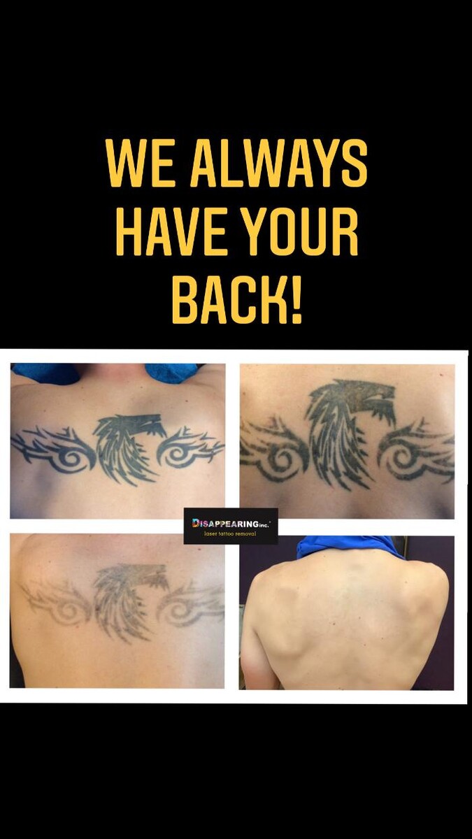 Images Removery Tattoo Removal & Fading