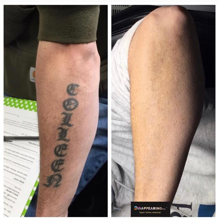 Images Removery Tattoo Removal & Fading