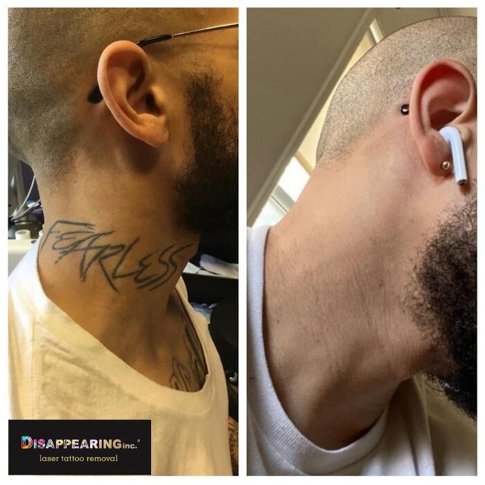 Images Removery Tattoo Removal & Fading