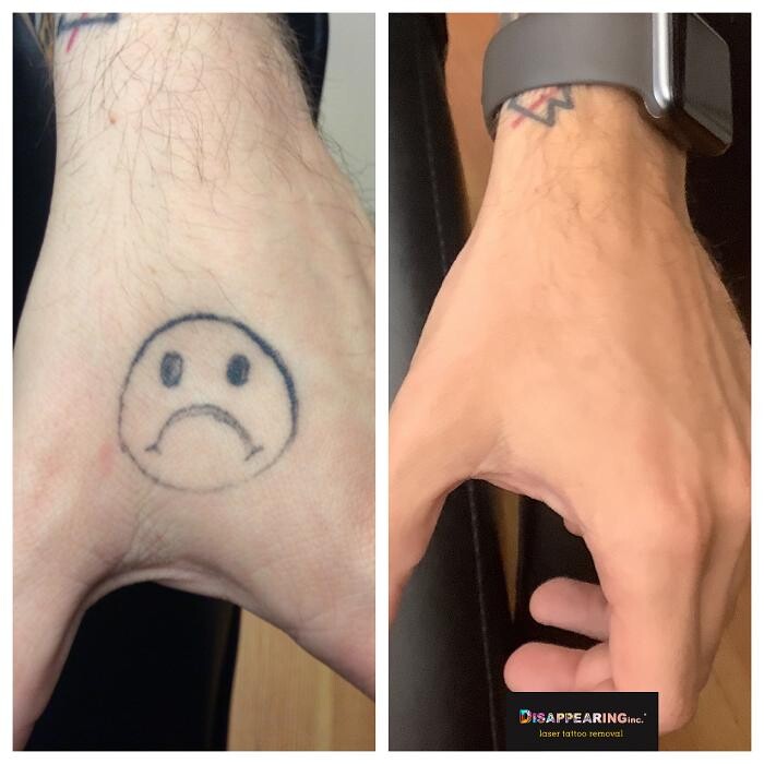 Images Removery Tattoo Removal & Fading