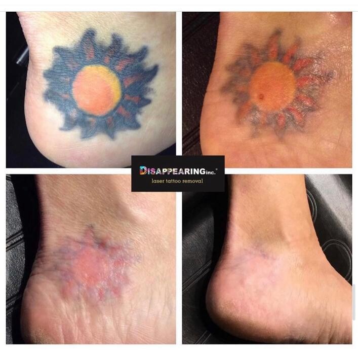 Images Removery Tattoo Removal & Fading
