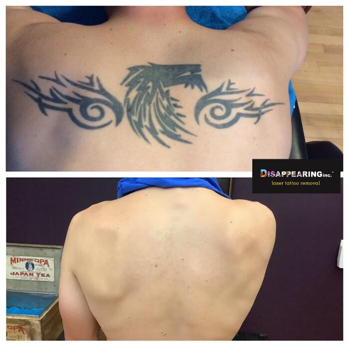 Images Removery Tattoo Removal & Fading
