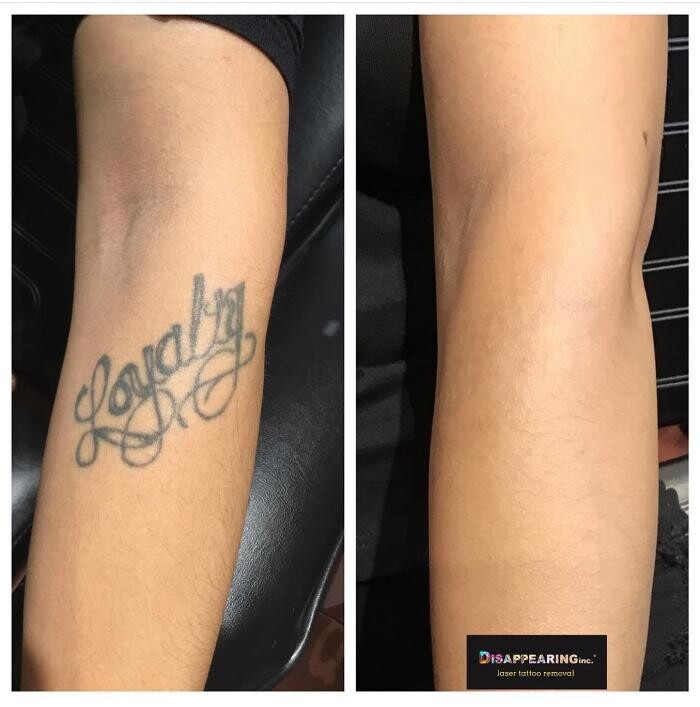 Images Removery Tattoo Removal & Fading
