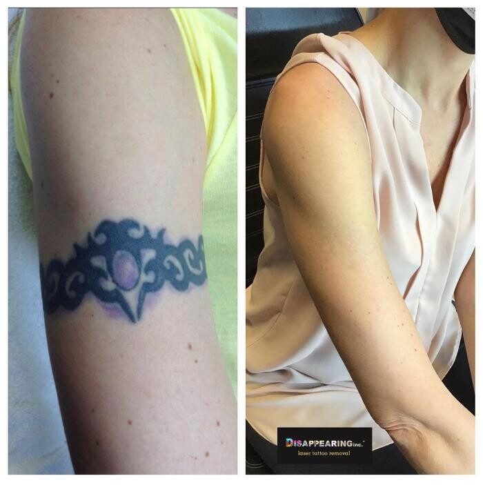 Images Removery Tattoo Removal & Fading