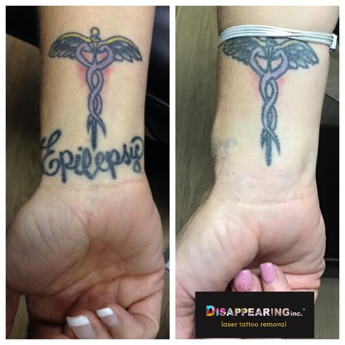 Images Removery Tattoo Removal & Fading