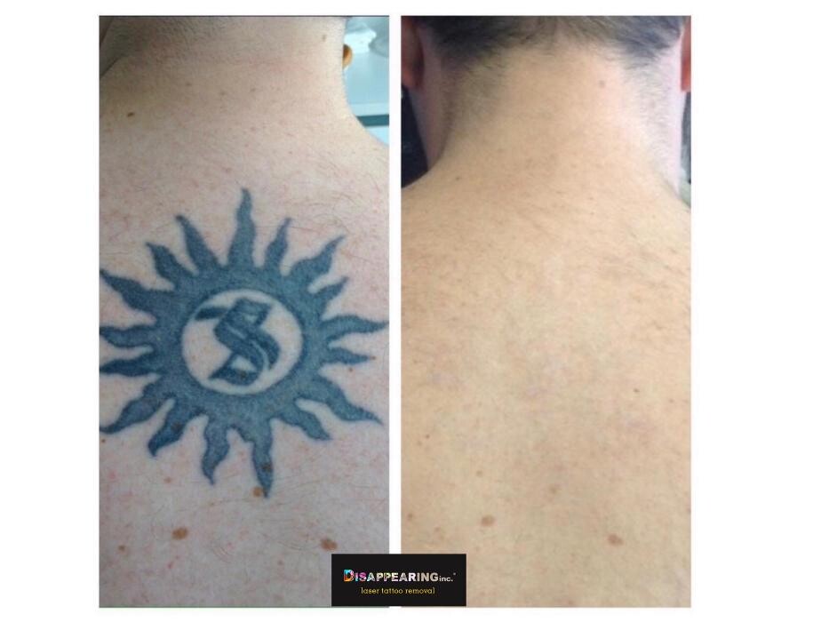 Images Removery Tattoo Removal & Fading