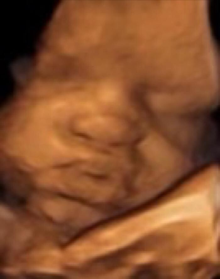 Images Miracle in the Womb