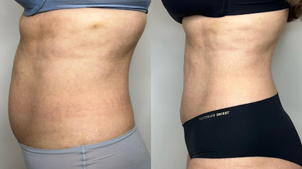 Images TS Browshes Esthetics and Laser