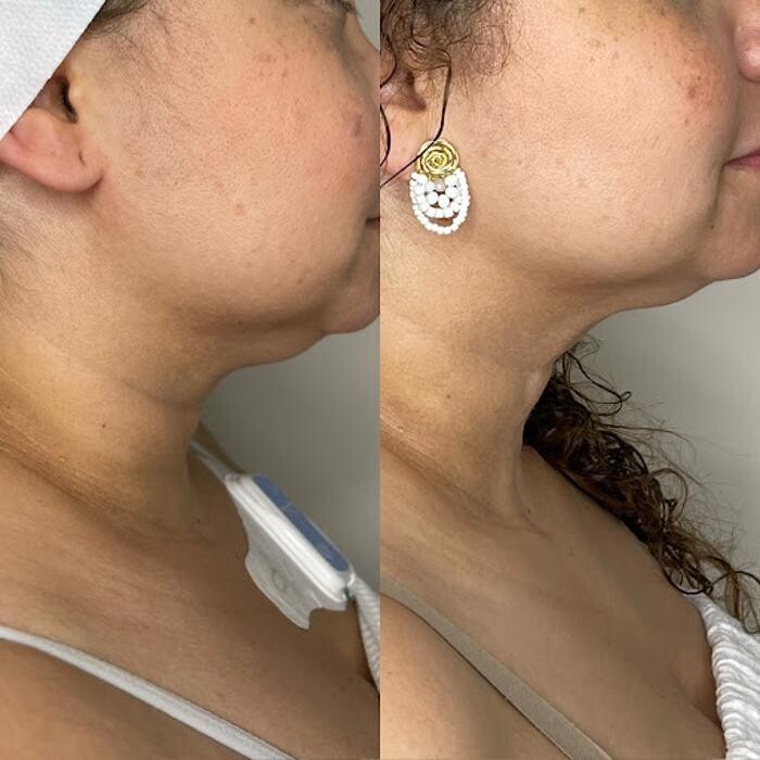 Images TS Browshes Esthetics and Laser