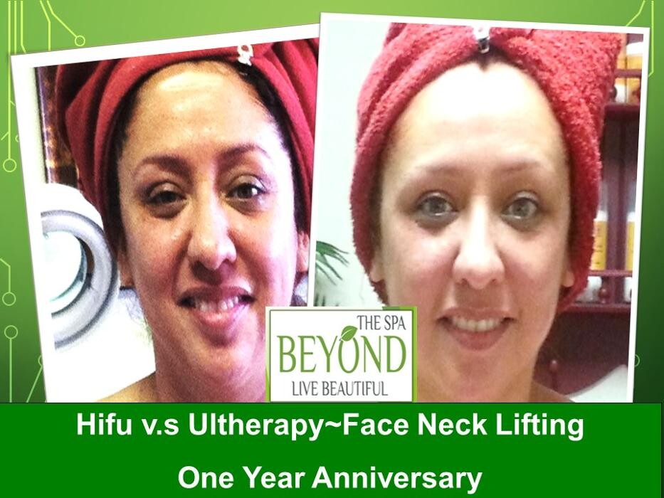 Images Beyond The Spa is #1 Specialized in HIFU-Ultherapy Trail: $499