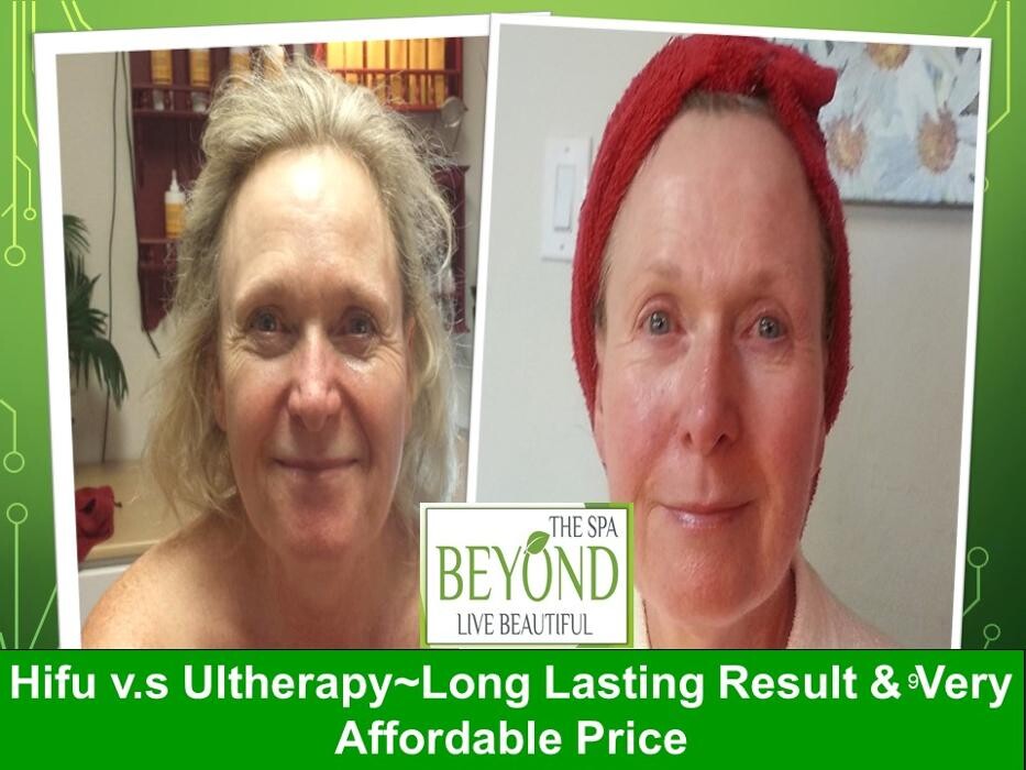 Images Beyond The Spa is #1 Specialized in HIFU-Ultherapy Trail: $499
