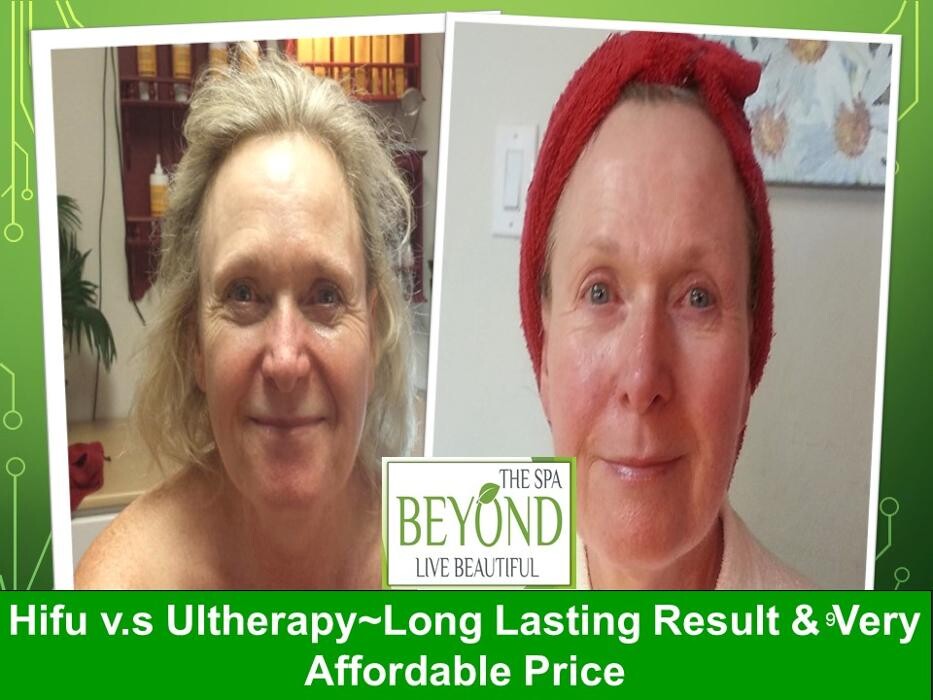 Images # 1 Specialized in Hifu Ultherapy Face & Neck Lift Trial $499