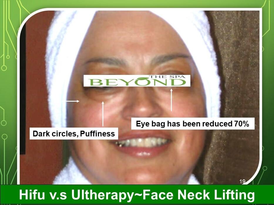 Images Beyond The Spa is #1 Specialized in HIFU-Ultherapy Trail: $499