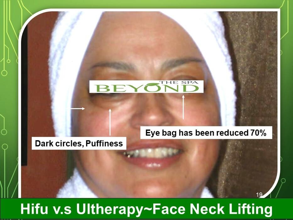 Images # 1 Specialized in Hifu Ultherapy Face & Neck Lift Trial $499