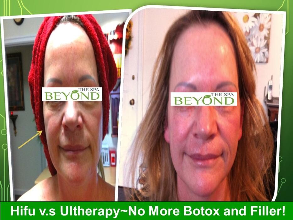 Images Beyond The Spa is #1 Specialized in HIFU-Ultherapy Trail: $499