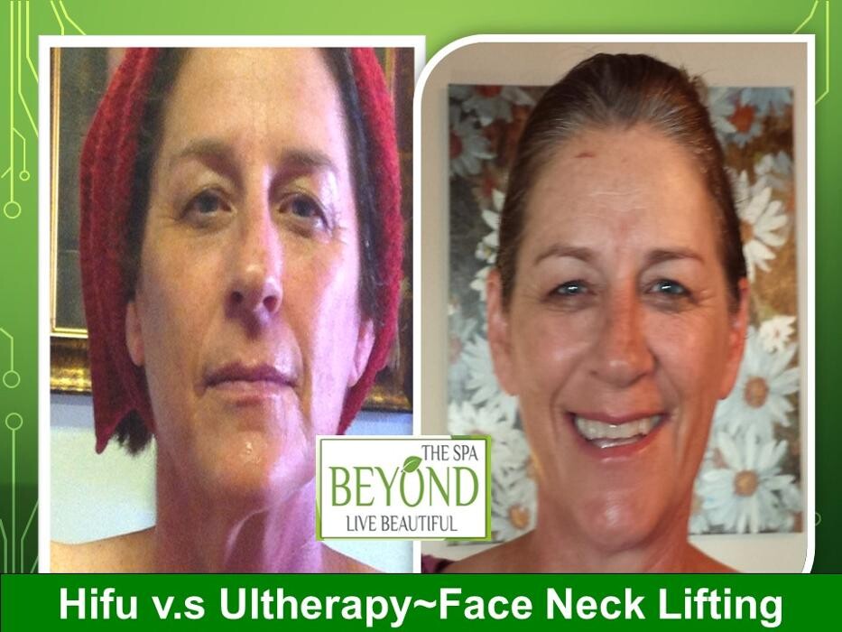 Images Beyond The Spa is #1 Specialized in HIFU-Ultherapy Trail: $499