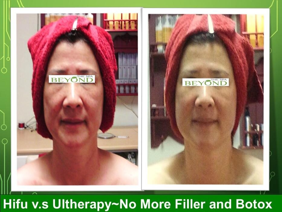 Images Beyond The Spa is #1 Specialized in HIFU-Ultherapy Trail: $499