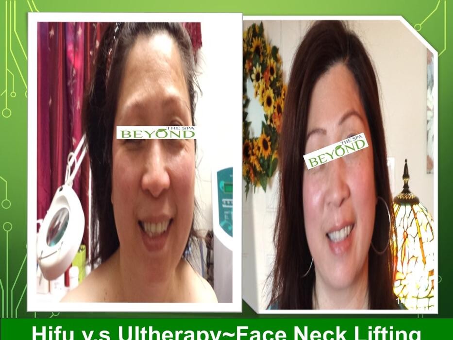Images Beyond The Spa is #1 Specialized in HIFU-Ultherapy Trail: $499