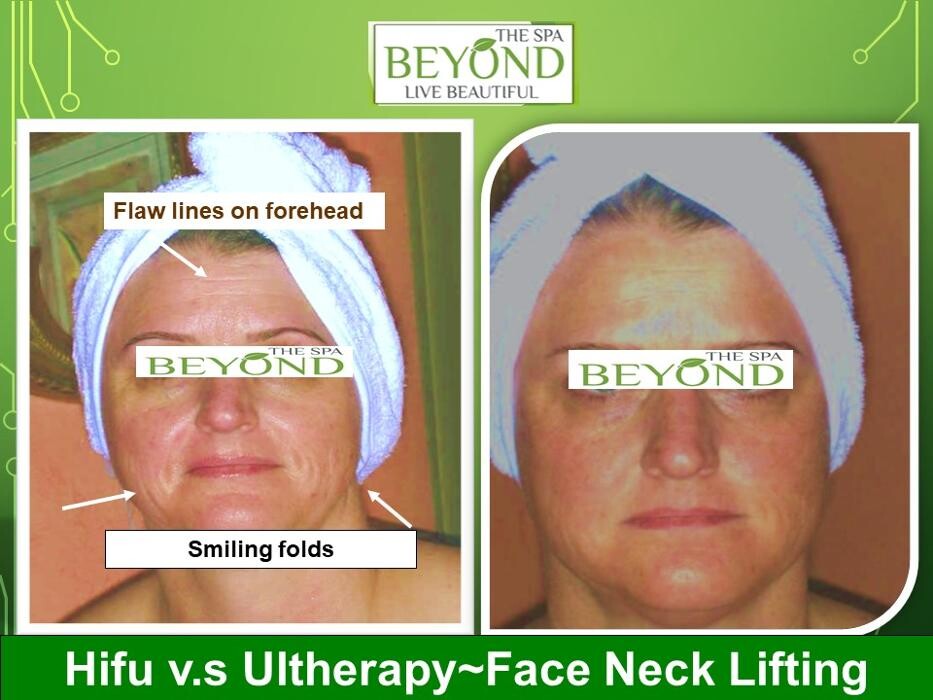 Images Beyond The Spa is #1 Specialized in HIFU-Ultherapy Trail: $499