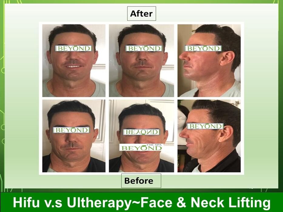 Images Beyond The Spa is #1 Specialized in HIFU-Ultherapy Trail: $499