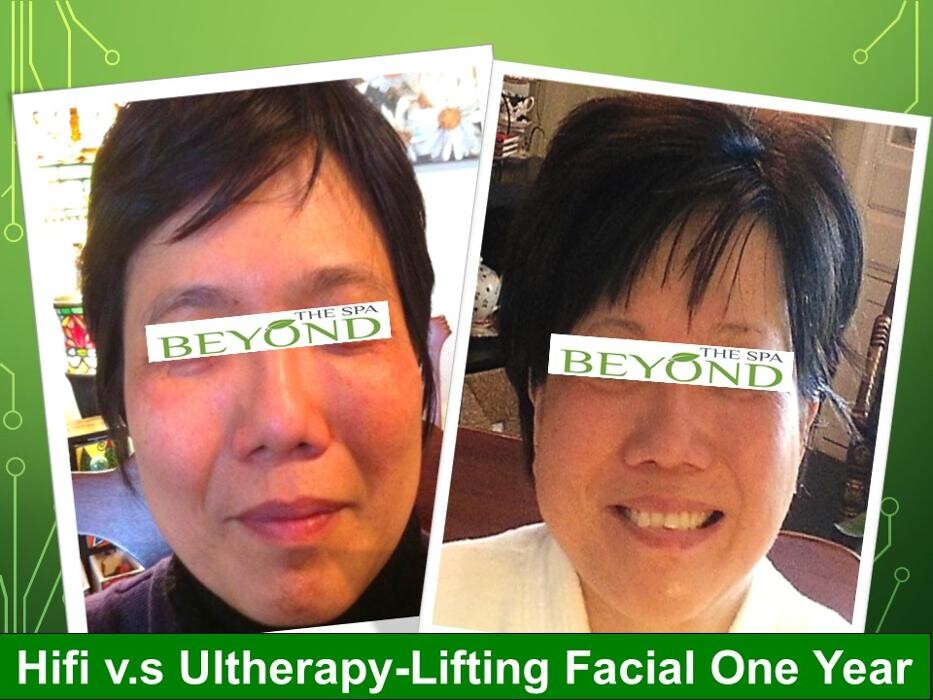 Images Beyond The Spa is #1 Specialized in HIFU-Ultherapy Trail: $499