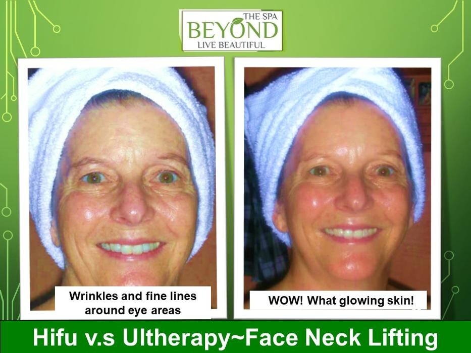 Images Beyond The Spa is #1 Specialized in HIFU-Ultherapy Trail: $499