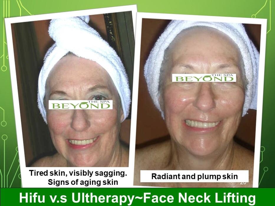 Images Beyond The Spa is #1 Specialized in HIFU-Ultherapy Trail: $499