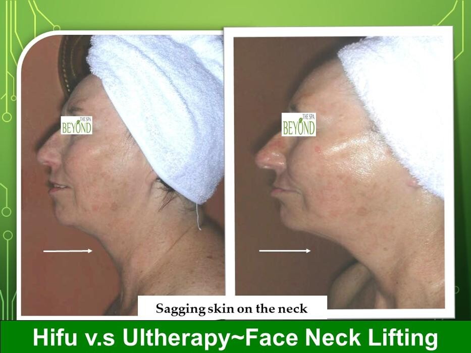 Images # 1 Specialized in Hifu Ultherapy Face & Neck Lift Trial $499