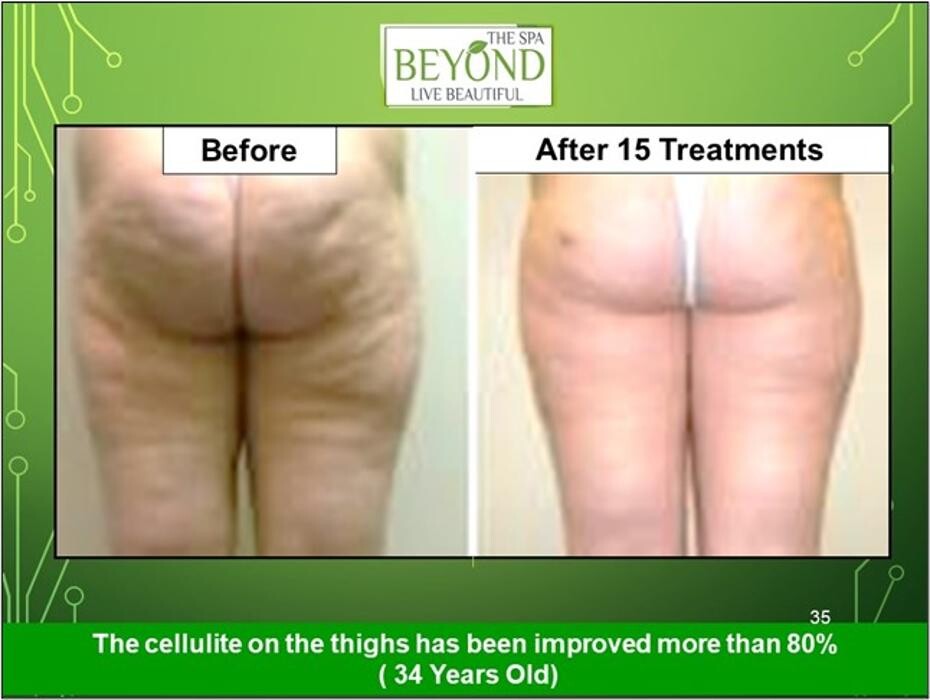 Images Beyond The Spa is #1 Specialized in HIFU-Ultherapy Trail: $499