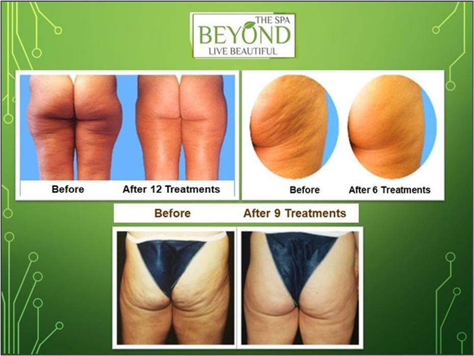 Images Beyond The Spa is #1 Specialized in HIFU-Ultherapy Trail: $499