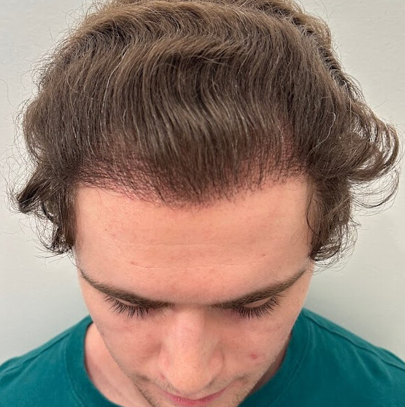 Images Hair Transplants Los Angeles