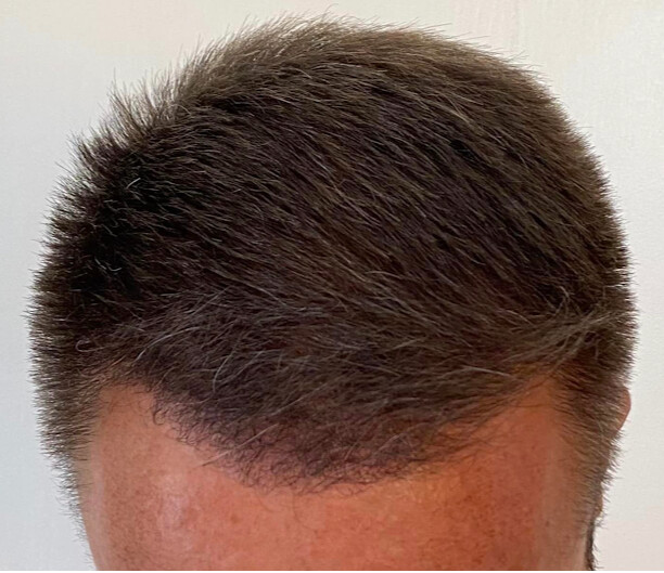 Images Hair Transplants Los Angeles