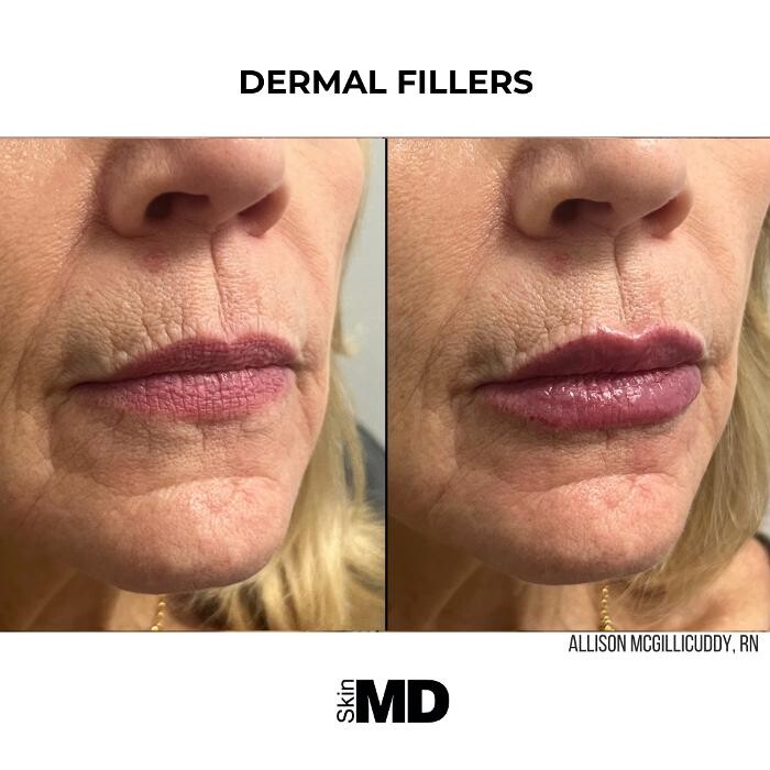 Images SkinMD Boston