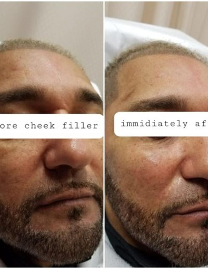 Images Injections By Sabina