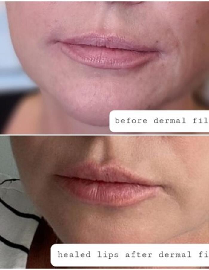 Images Injections By Sabina
