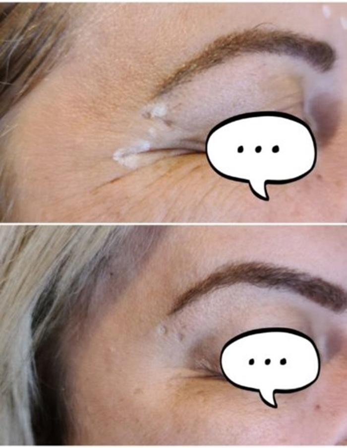 Images Injections By Sabina