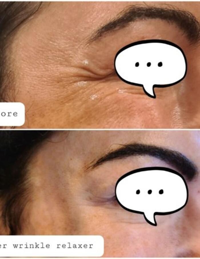 Images Injections By Sabina
